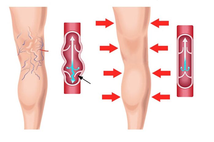 effect van Levicose-gel in de behandeling