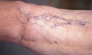 methoden voor de behandeling van spataderen op de benen