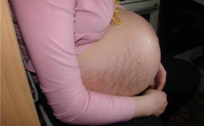 oorzaken van spataderen tijdens de zwangerschap