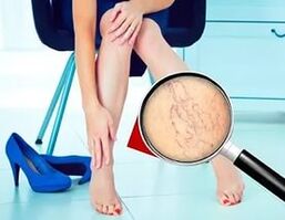 De symptomen zijn afhankelijk van de aard en het stadium van spataderen