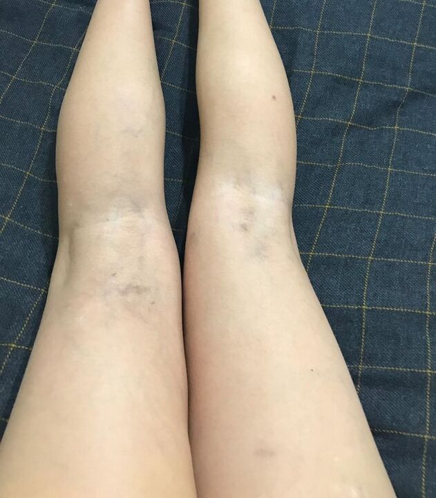 manifestaties van spataderen op de benen