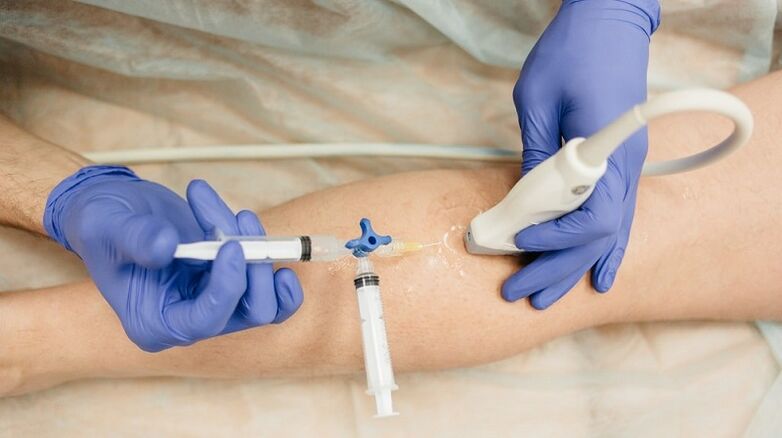 sclerotherapie voor spataderen