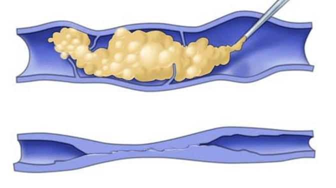 sclerotherapie voor spataderen